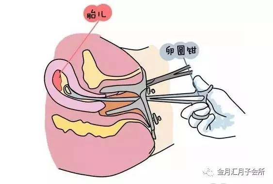 关于六个月流产的处理方式与心理调适