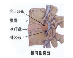 腰疼两个月，原因与解决方案